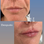 Embellecimiento Tercio Inferior